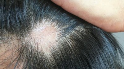 Estudos acadmicos abordam a ligao entre a queda de cabelo acentuada e Covid-19, mas as causas, a durao e os tratamentos ainda no esto muito claros.