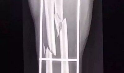 Radiografia mostra a fratura no brao da mulher (Foto: divulgao / Polcia Civil)
