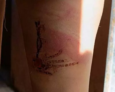 Perna da adolescente de 12 anos agredida pelo pai na noite de ontem (20) (Foto:Divulgao PM)
