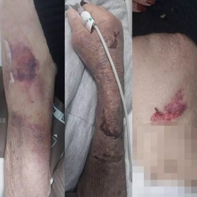 Parte das leses encontradas no corpo do idoso aps ser internado (Foto: TL Notcias)